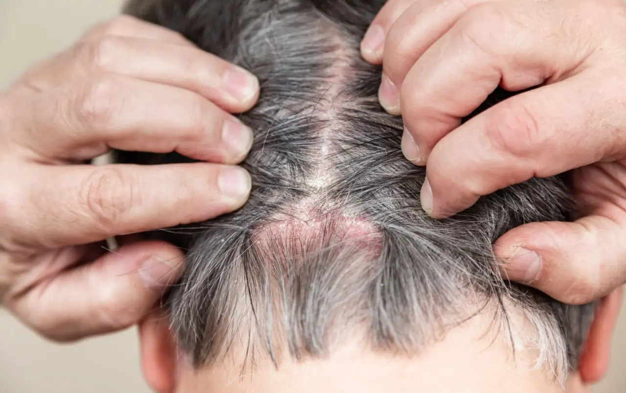Dermatite seborroica: ecco le abitudini quotidiane comuni che la peggiorano senza saperlo