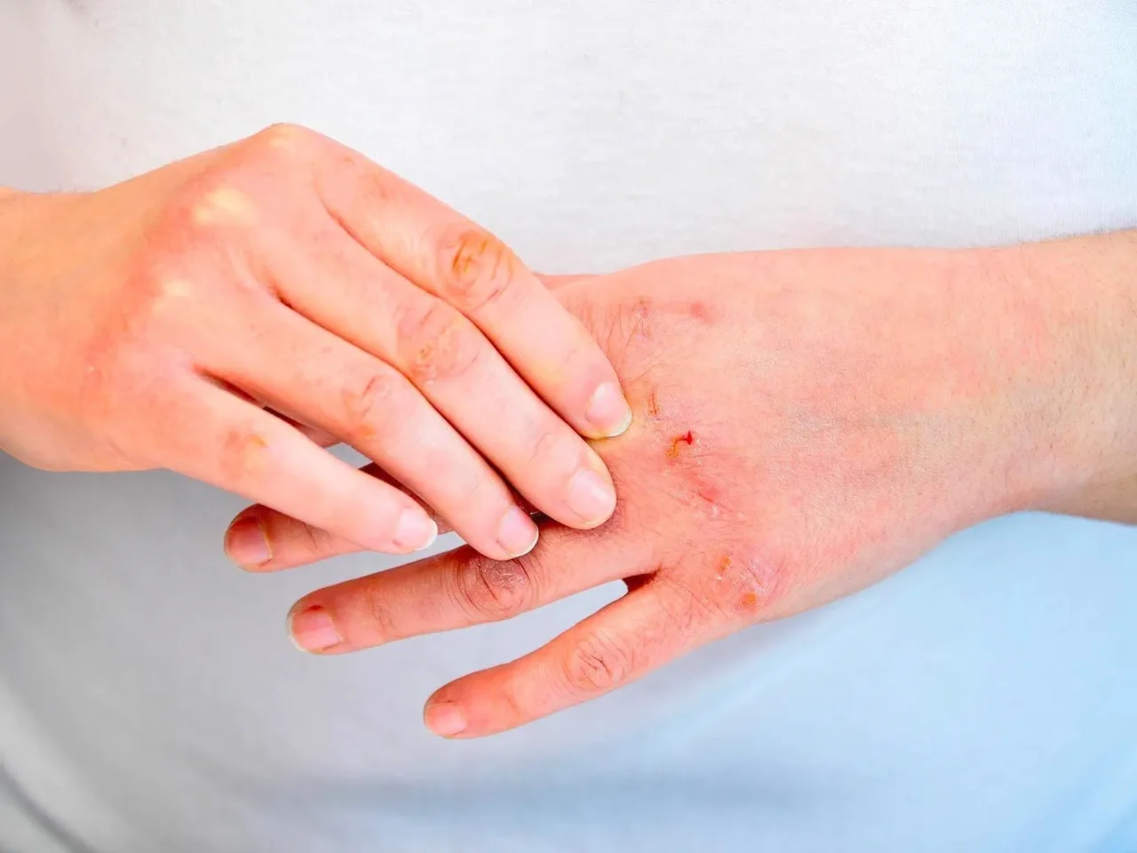 Soffri di eczema? Ecco i cibi che ti infiammano la pelle e devi assolutamente evitare